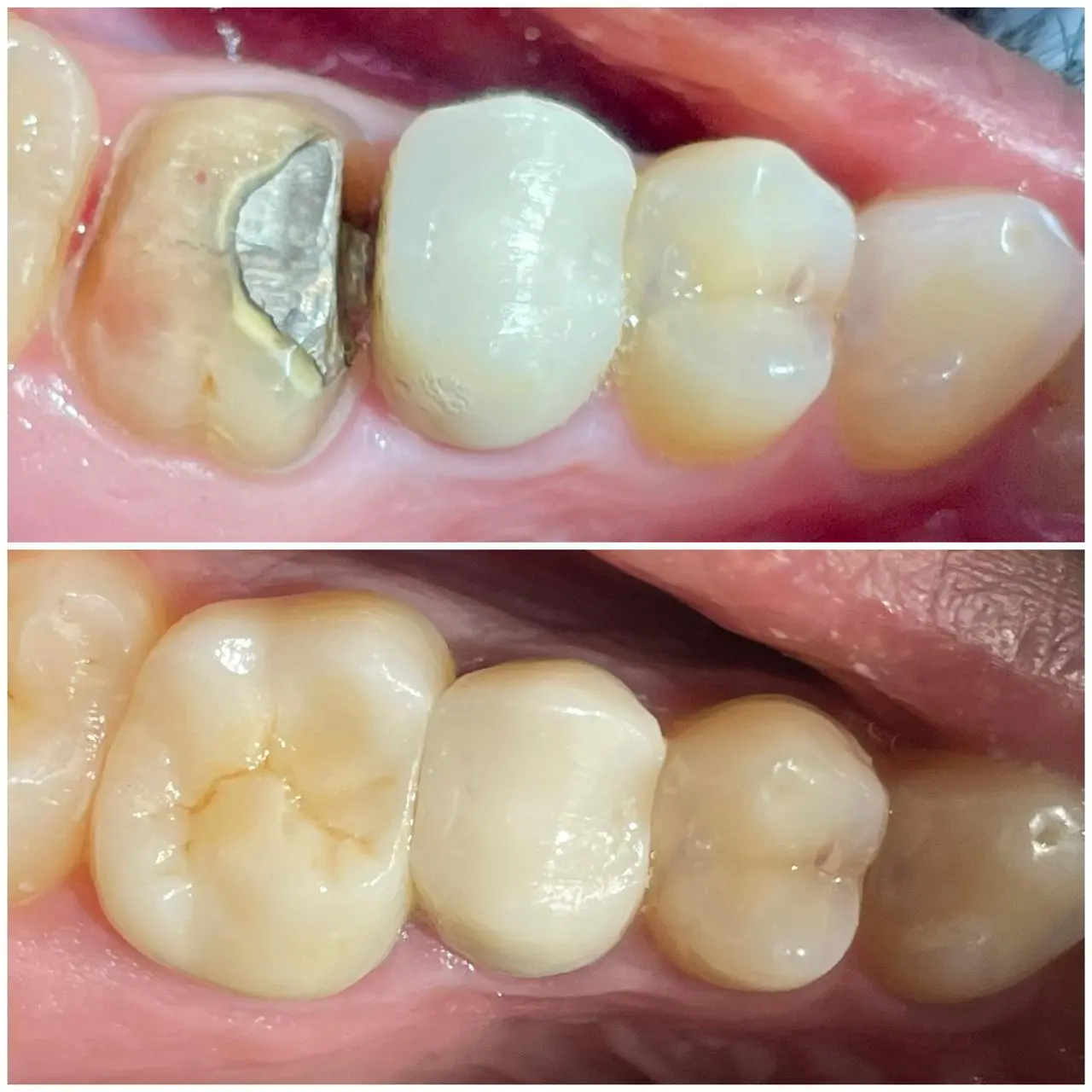 Dental Crown and Bridge Treatment