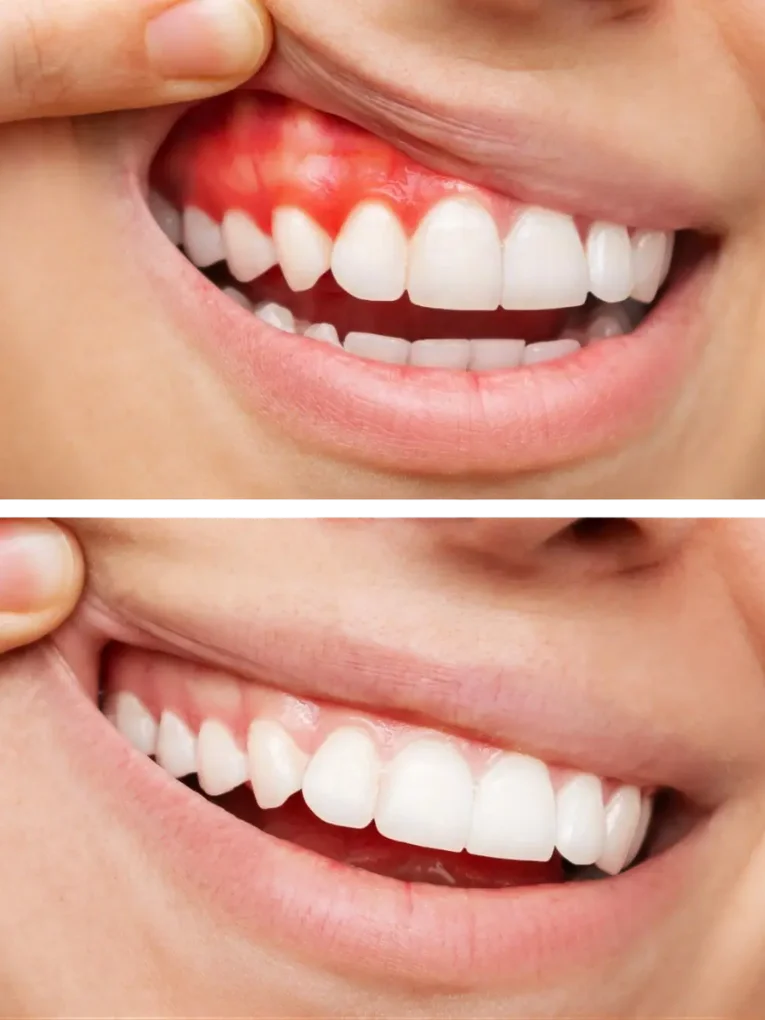 Gum Disease Treatment at TeethTime