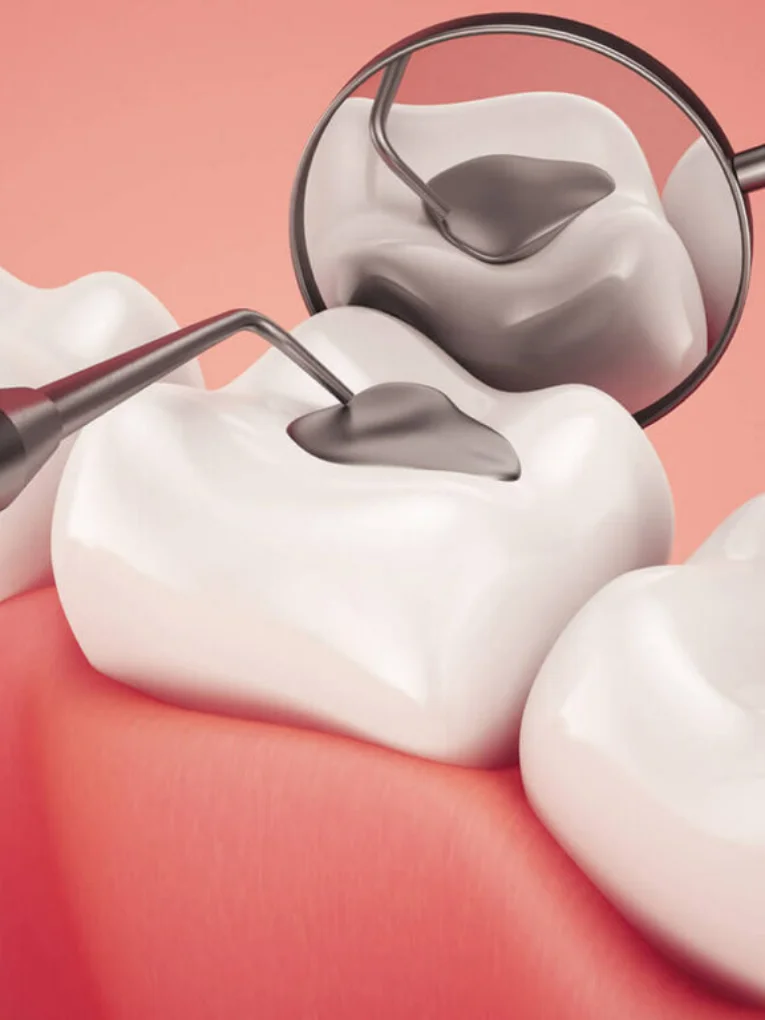 Dental Fillings Treatment at TeethTime