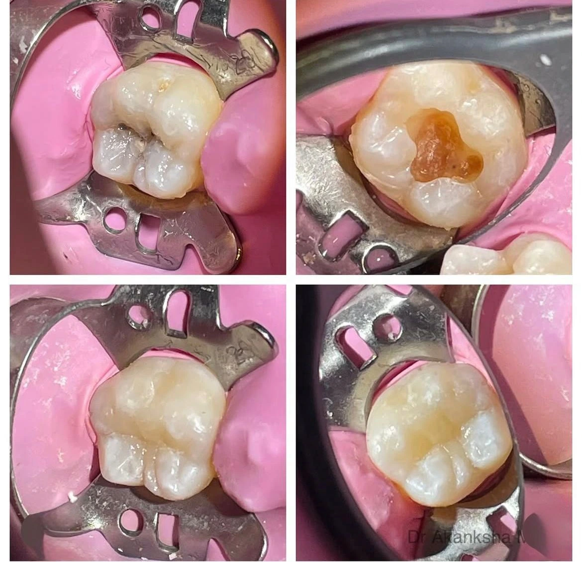 Dental Fillings Treatment at TeethTime
